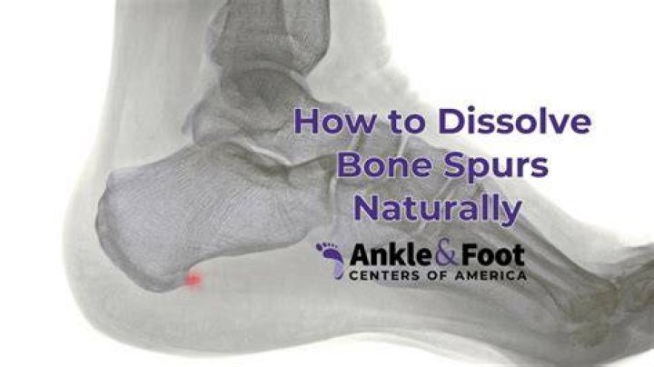 Can foot bone spurs disappear?