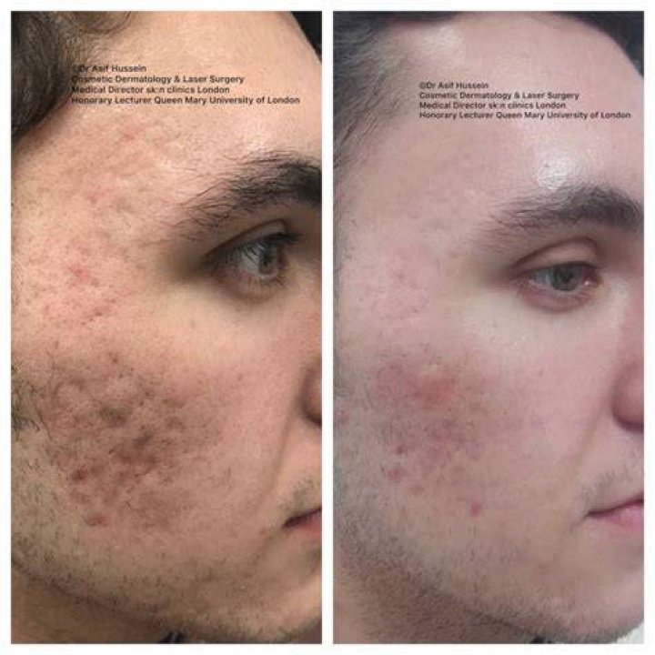 What is the best treatment for acne scars?